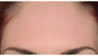 Botox Marquette