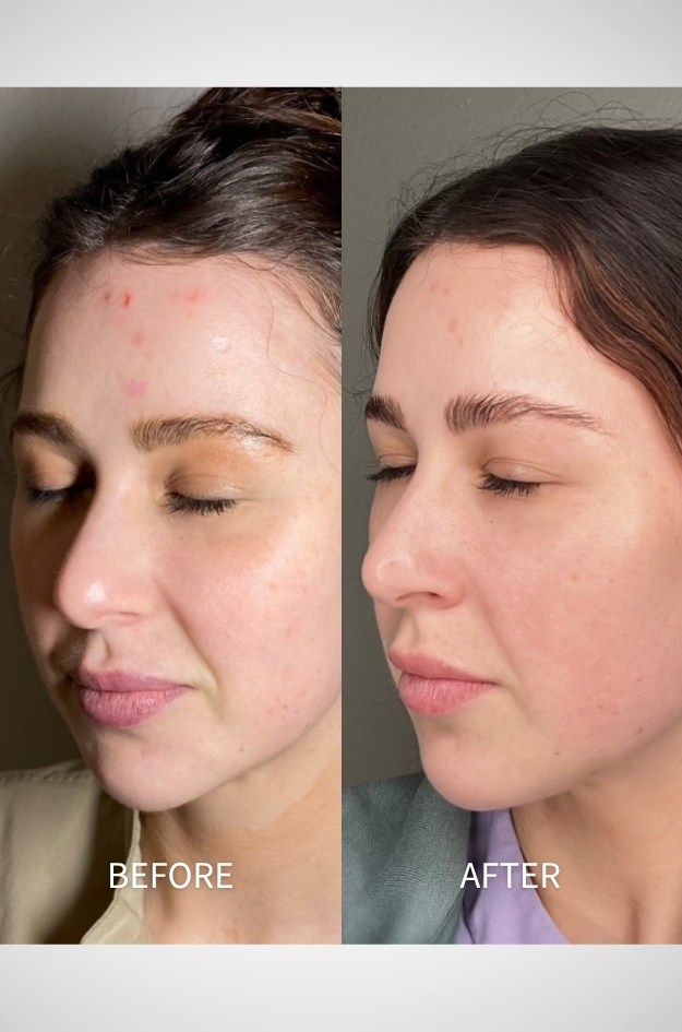 Microinfusion Skin Treatment in Marquette MI