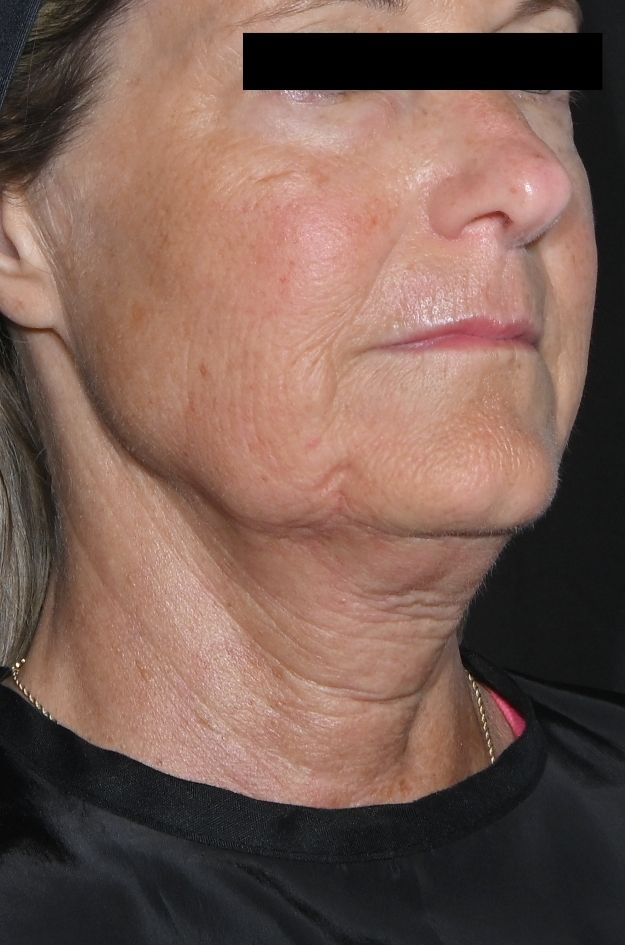 Microneedling in Marquette MI